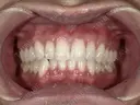 医療オフィスホワイトニング＋エアフロー＆歯石・歯垢除去 after画像 サムネイル用