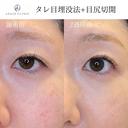 タレ目＋目尻切開 before画像 サムネイル用