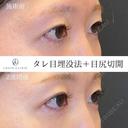 タレ目＋目尻切開 14日後 サムネイル用