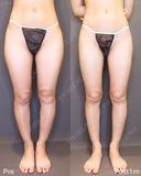 脂肪吸引（大腿前面・後面） before画像 サムネイル用