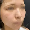 鼻先ヒアルロン酸 before画像 サムネイル用