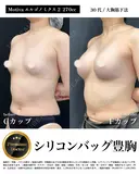 シリコンバッグ豊胸 Motivaエルゴノミクス2 270cc before画像 サムネイル用