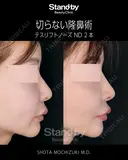 切らない隆鼻術：テスリフトノーズND 30日後 サムネイル用