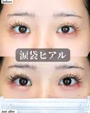 涙袋ヒアルロン酸 before画像 サムネイル用