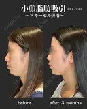 小顔脂肪吸引　アキーセル併用 before画像 サムネイル用