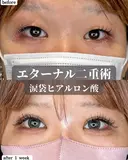 エターナル二重術・涙袋ヒアルロン酸 before画像 サムネイル用