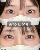 涙袋ヒアルロン酸 after画像 サムネイル用