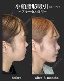 小顔脂肪吸引　アキーセル併用 before画像 サムネイル用