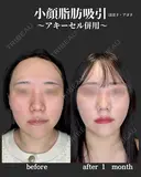 小顔脂肪吸引　アキーセル併用 after画像 サムネイル用