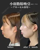 小顔脂肪吸引　アキーセル併用 after画像 サムネイル用