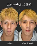 エターナル二重術 before画像 サムネイル用