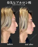 鼻先ヒアルロン酸 before画像 サムネイル用