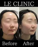 ピコトーニング+白玉点滴 before画像 サムネイル用
