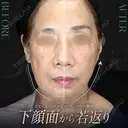 フェイスリフト＋ジョールファット除去 before画像 サムネイル用