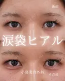 涙袋ヒアルロン酸 before画像 サムネイル用