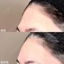おでこ・こめかみのデザイン注射（ヒアルロン酸） before画像 サムネイル用