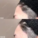 おでこ・こめかみのデザイン注射（ヒアルロン酸） 0日後 サムネイル用