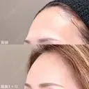 おでこ・こめかみのデザイン注射（ヒアルロン酸） 30日後 サムネイル用