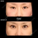  GX 眼瞼下垂手術＋下眼瞼切開術（裏ハムラ法）（術後2ヶ月後右目眼瞼下垂修正術＋左目二重修正術） 240日後 サムネイル用