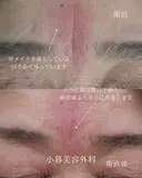 眉間ヒアルロン酸 before画像 サムネイル用