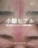 眉間ヒアルロン酸 0日後 サムネイル用