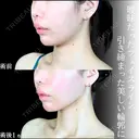 頬・あご下脂肪吸引 /糸リフト/ジョールファット/エラボトックス before画像 サムネイル用