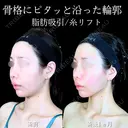頬・あご下脂肪吸引 /糸リフト/ジョールファット/エラボトックス 30日後 サムネイル用
