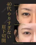 眉下切開 30日後 サムネイル用