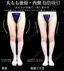 後方・内側太もも脂肪吸引 before画像 サムネイル用