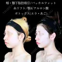 頬・顎下脂肪吸引/バッカルファット/ジョールファット/エラボトックス/糸リフト/顎ヒアルロン酸・ボトックス before画像 サムネイル用
