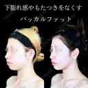 頬・顎下脂肪吸引/バッカルファット/ジョールファット/エラボトックス/糸リフト/顎ヒアルロン酸・ボトックス 180日後 サムネイル用