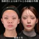 術後1年 肋軟骨よる鼻中隔延長、耳介軟骨移植、鼻尖形成、鼻孔縁下降、小鼻縮小外側、ソフトプロテーゼ 額、こめかみ、目の下、ゴルゴ脂肪吸引 before画像 サムネイル用