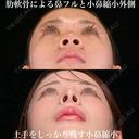 術後1年 肋軟骨よる鼻中隔延長、耳介軟骨移植、鼻尖形成、鼻孔縁下降、小鼻縮小外側、ソフトプロテーゼ 額、こめかみ、目の下、ゴルゴ脂肪吸引 365日後 サムネイル用
