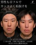 【術式：二重全切開、タレ目手術、目尻切開】 の組み合わせ目フルの症例です。 60日後 サムネイル用