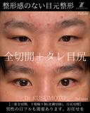 【術式：二重全切開、タレ目手術、目尻切開】 の組み合わせ目フルの症例です。 60日後 サムネイル用