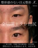 【術式：二重全切開、タレ目手術、目尻切開】 の組み合わせ目フルの症例です。 60日後 サムネイル用