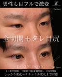 【術式：二重全切開、タレ目手術、目尻切開】 の組み合わせ目フルの症例です。 60日後 サムネイル用