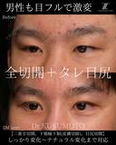 【術式：二重全切開、タレ目手術、目尻切開】 の組み合わせ目フルの症例です。 60日後 サムネイル用