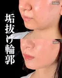 岩﨑先生による🔥小顔整形🔥 after画像 サムネイル用