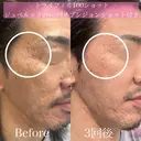 トライフィルプロ100ショット　ジュベルック2㏄　サブシジョンショット付き before画像 サムネイル用
