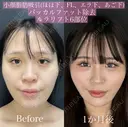 顔脂肪吸引（ホホフェイスライン、アゴ下エラ下）・バッカルファット除去・ルラリフト6部位 before画像 サムネイル用
