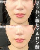 ほうれい線ヒアルロン酸 before画像 サムネイル用