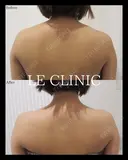 肩ボトックス before画像 サムネイル用