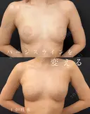 お腹全周脂肪吸引＋脂肪豊胸 before画像 サムネイル用