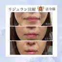 リジュラン注射『ほうれい線』 7日後 サムネイル用