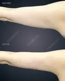 二の腕脂肪吸引 before画像 サムネイル用