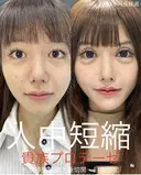 人中短縮・貴族プロテーゼ・眼瞼下垂・目頭切開 after画像 サムネイル用