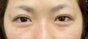 二重埋没3点留め 30日後 サムネイル用