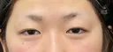二重埋没3点留め before画像 サムネイル用