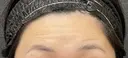 額ボトックス before画像 サムネイル用